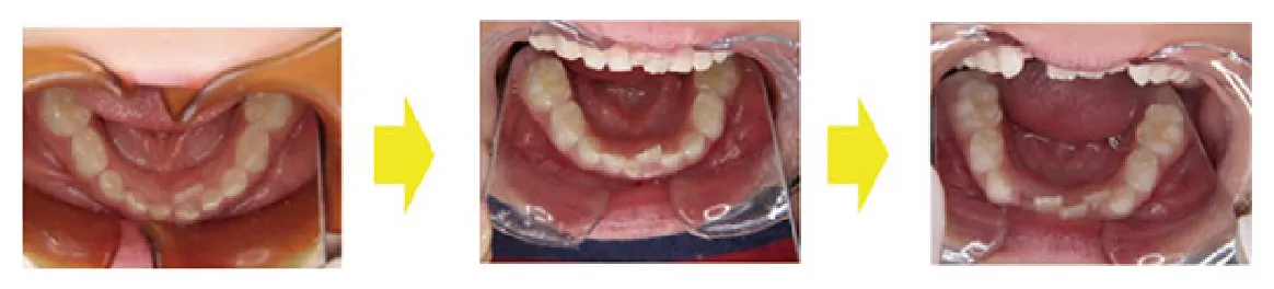 永久歯がきれいに並ぶかどうかは６歳ぐらいの前歯が生え変わるときに決まる