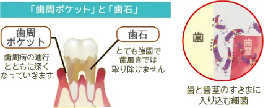 細菌が歯を支えている骨を溶かします