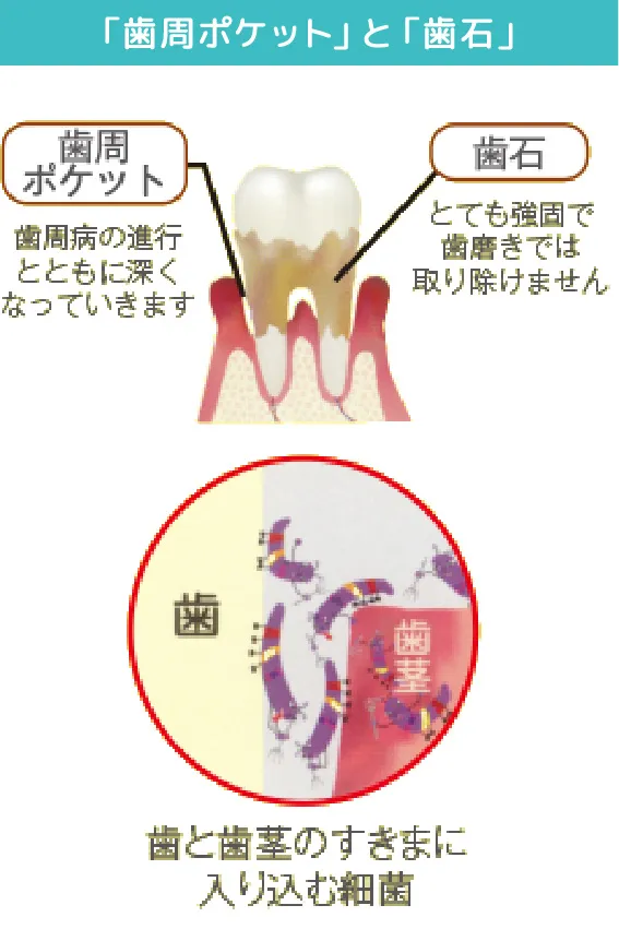 細菌が歯を支えている骨を溶かします